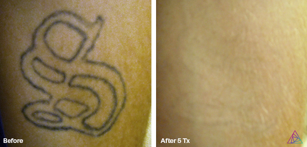 Before and after tattoo removal